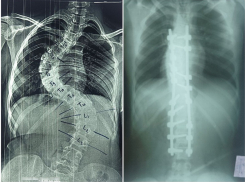 Девочке-подростку из Запорожской области 4 часа исправляли искривление позвоночника 