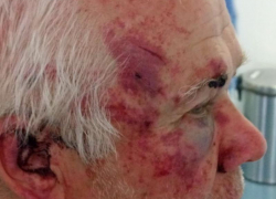 Опубликованы жуткие фото последствий избиения пенсионера разъяренным дачником в Запорожье