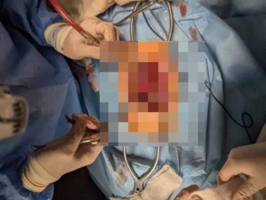 Девочке, пострадавшей при атаке ВСУ на Черниговский район, сделали операцию на позвоночнике
