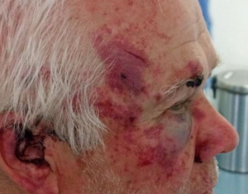 Опубликованы жуткие фото последствий избиения пенсионера разъяренным дачником в Запорожье